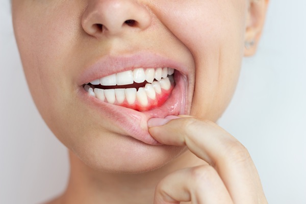 Scaling And Root Planing: Treatment For Gum Disease